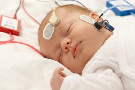 BERA-e-PEAEE-estado-estável-infantis